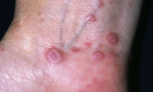 تجربتي مع مرض الحزاز