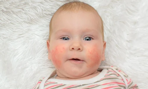 ما هي اكزيما الرضع والفازلين؟
