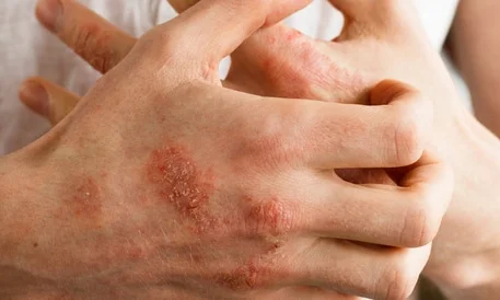 ما هو علاج الاكزيما جابر القحطاني؟