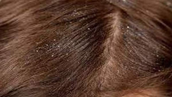 تعرف على تفسير حلم قتل القمل في المنام لابن سيرين