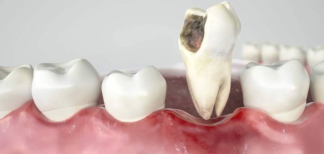 تفسير حلم خلع الضرس مع نزول دم لابن سيرين