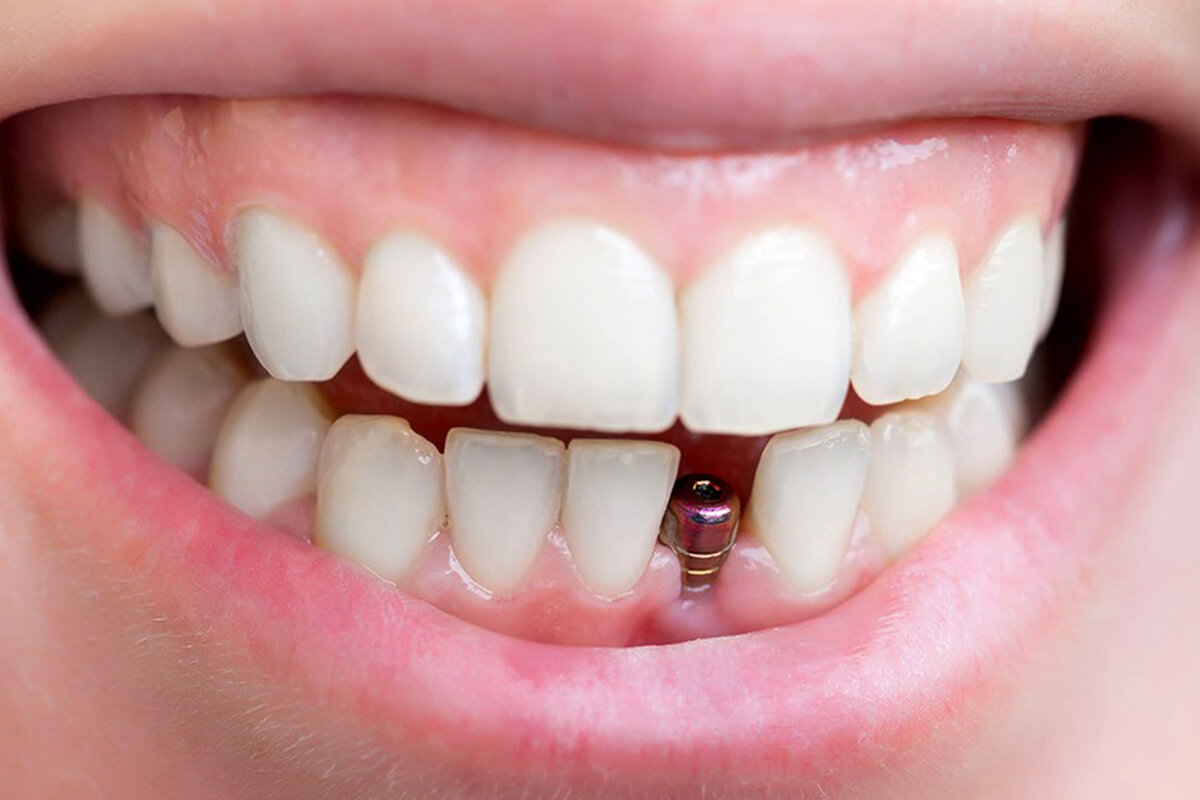 تفسير حلم سقوط الأسنان السفلية لابن سيرين