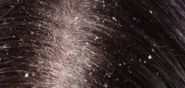 ما تفسير حلم القشرة في الشعر في المنام لابن سيرين