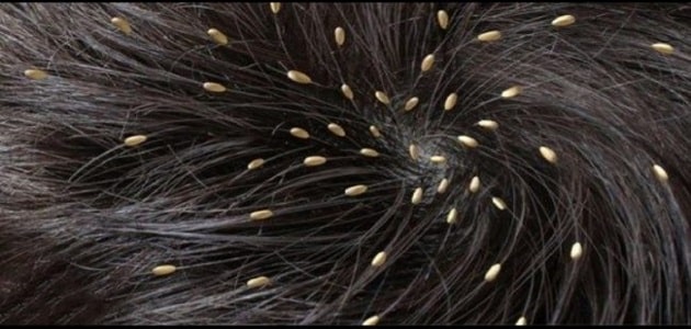 تفسير حلم القمل الأسود في الشعر للعزباء لابن سيرين