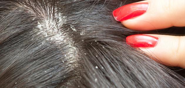 ما تفسير حلم القمل لابن سيرين